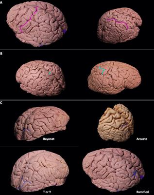 Topographic anatomy of the lateral surface of the parietal lobe and its relationship with white matter tracts